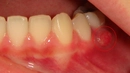 Dental Apse Belirtileri ve Tedavisi